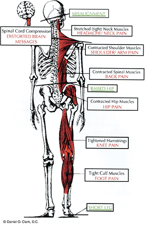 Short leg and body pain. Posture from short leg leads to health issues —  NUCCA Upper Cervical Chiropractic Dallas-Fort Worth