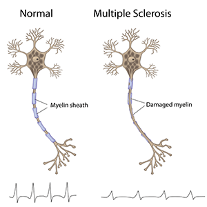 natural treatment for multiple sclerosis in Edwardsville, IL