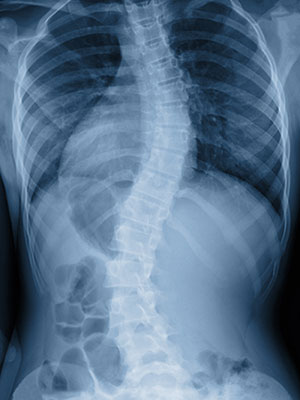Natural treatment for scoliosis in Edwardsville, IL at Upper Cervical Care